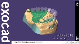 INSIGHTS 2018: PartialCAD Case Demonstration - Telescopic crowns and a partial Part II