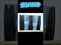 Distal femur fracture with bone loss!! Does it heal ? #baramati #bobadehospital #orthopedicsurgeon