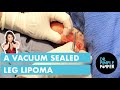 A Vacuum Sealed Leg Lipoma