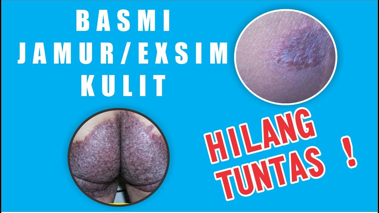 Cara Mengobati Selangkangan Gatal, Lecet dan Hitam