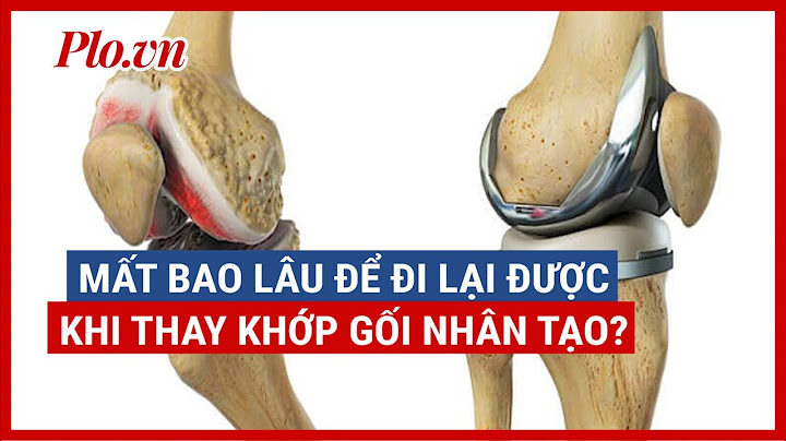 Mổ thay khớp gối bao nhiêu tiền năm 2024