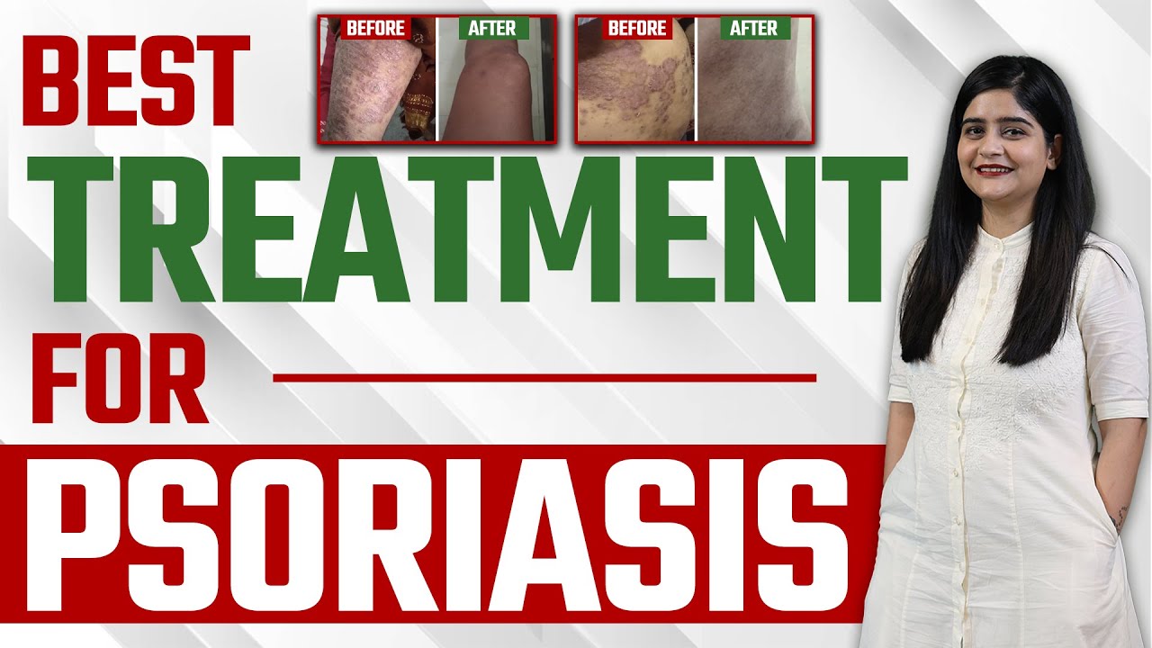 Best Treatment For Psoriasis सोरायसिस हुआ जड़ से खत्म Dr Health