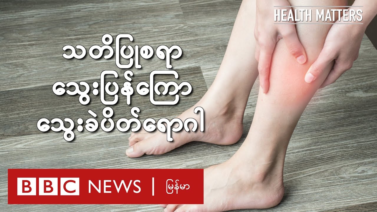 သတိပြုစရာ သွေးပြန်ကြော သွေးခဲပိတ်ရောဂါ - BBC News မြန်မာ