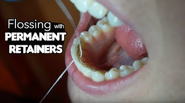 How To Floss with Permanent Retainer (Flossing Tricks)