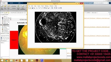 Automatic detection of retinal lesions for screening of diabetic retinopathy matlab projects code