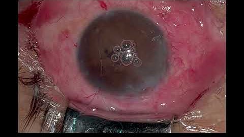 Agarwal Pupilloplasty