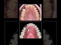 How to pull teeth underground when braces