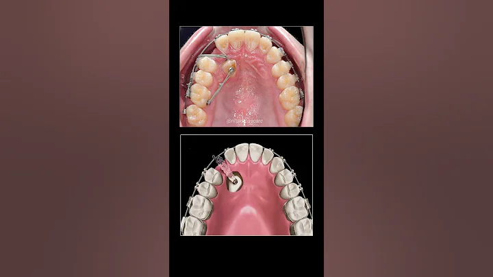 How to pull teeth underground when braces? - DayDayNews
