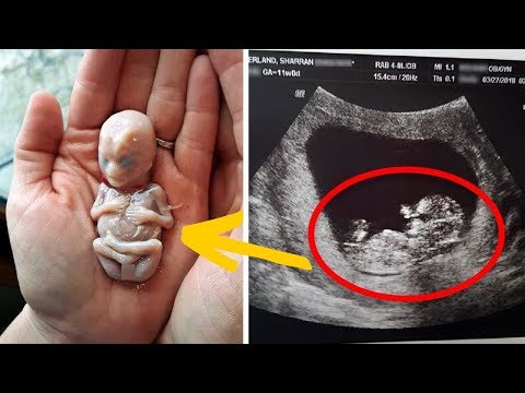 Video: The Woman Gave Birth To A Child With An Embryo Inside - Alternative View