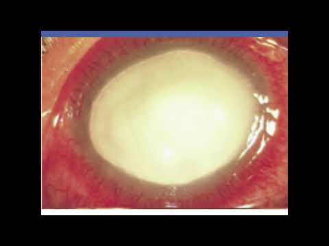 Video: Мышыктардагы көздүн корнеалдык сезгениши (Nonulcerative Keratitis)