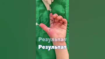 Синдактилия