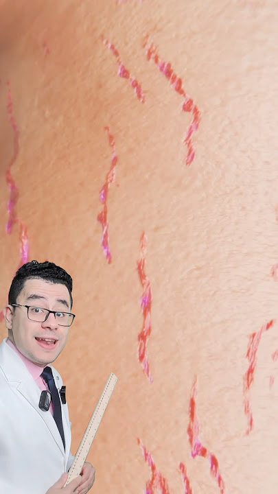 افضل علاج لعلامات التمدد الجلدي