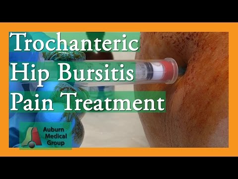 Video: Hvordan behandles trochanterisk bursitis?