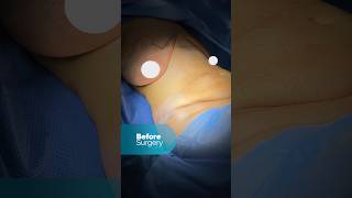 Live From Operating Room 360 Tummy Tuck And Breast Lift Surgery At