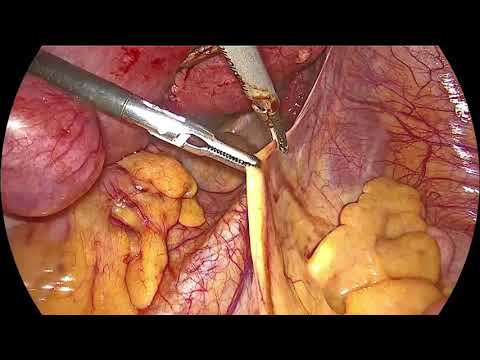 Total laparoscopic hysterectomy with bilateral oophorectomy surgery performed on 45 year old patient