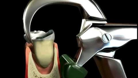 Austin TX Dentist Shares Video Animation of Tooth Removal with Physics Forceps Tool