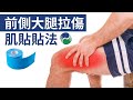 大腿前側肌肉拉傷的肌內效貼貼法 【肌貼】| Front Thigh Taping