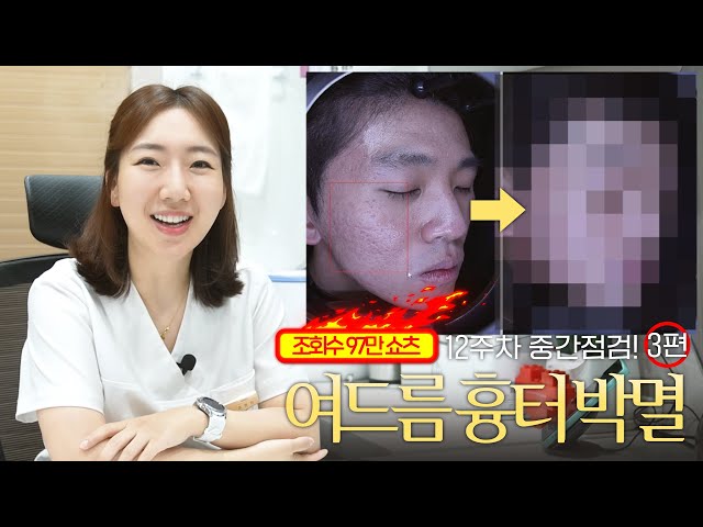 여드름 유형별 분석, 이 남자를 아십니까…? 여드름 흉터박멸 최종장 전 프리뷰