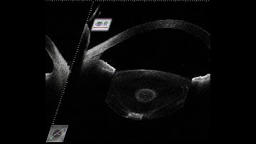 ASOCT in cataract surgery - Supplementary video 4 [ID 286996]