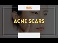 Acne Scars (PART 2) | Usapang Pangkalusugan