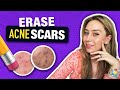 How to treat  fade acne scars like a dermatologist  dr shereene idriss