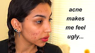 Acne ruined my self esteem