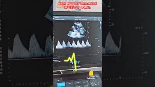 Color Doppler Ultrasound For Baby Growth #pregnancy #baby #ultrasound #doppler #heartbeat #yt