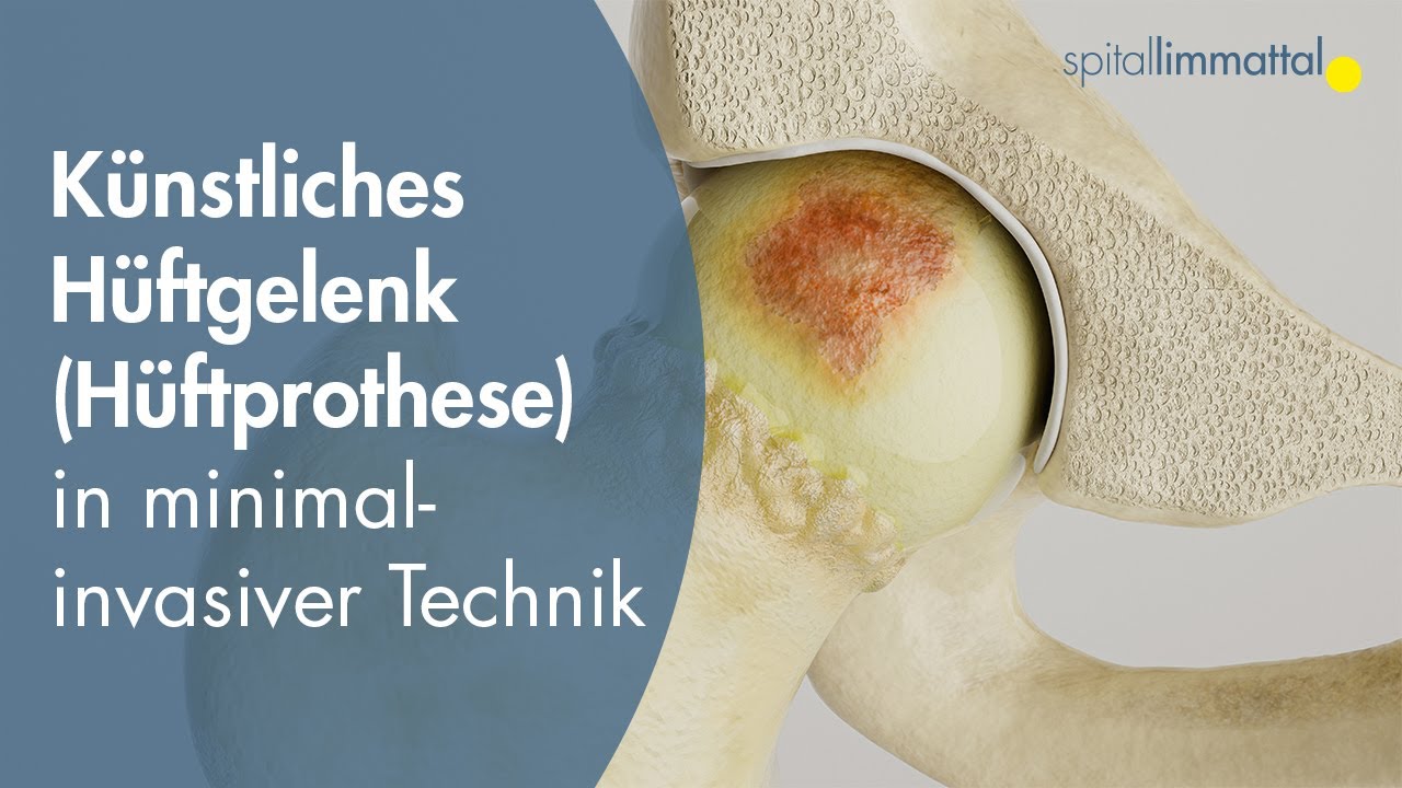 Knstliches Hftgelenk (Hftprothese) - Hftgelenkersatz in  minimal-invasiver Technik