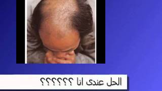 زراعة الشعر.wmv.flv