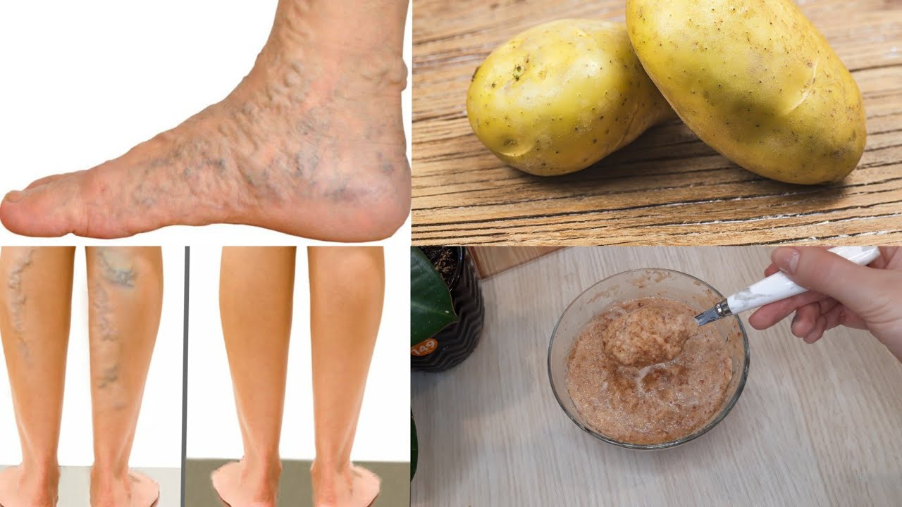 Попрощайтесь с варикозом навсегда..Невероятный.Стирает варикоз как ...