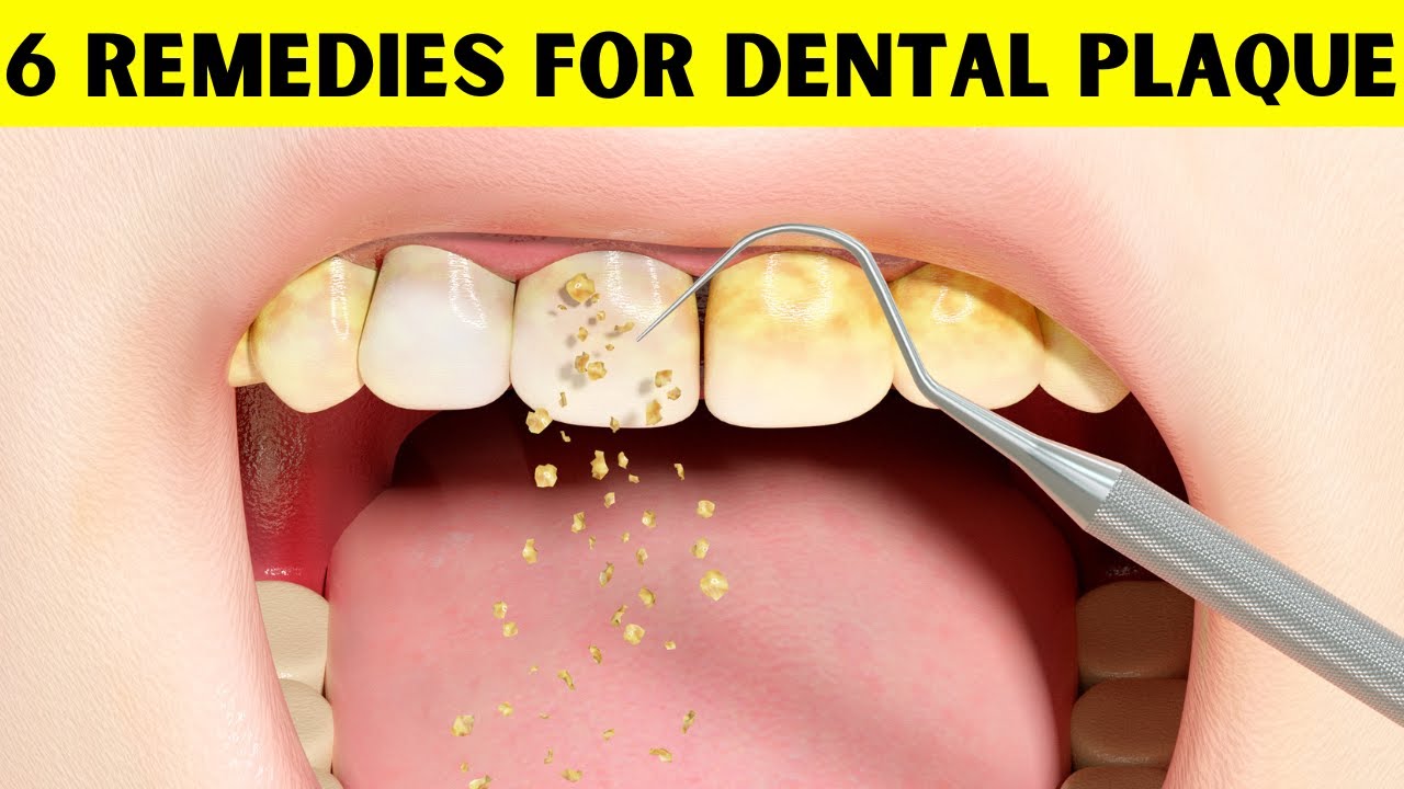 How To Get Rid Of Gritty Feeling On Teeth 6 Natural Remedies For Dental Plaque - How To Get Rid Of Dental Plaque