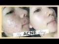 SKINCARE VÀ CHẾ ĐỘ SINH HOẠT KHI BỊ MỤN | NHẬT KÝ TRỊ MỤN TỪ A - Z CỦA CHANG