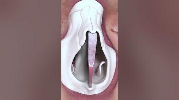 Making a crooked and deviated nose straight