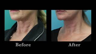 Erbium Resurfacing Laser Treatment For The Neck