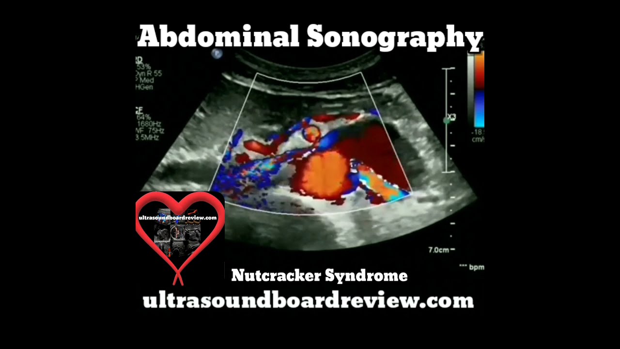 Nutcracker Syndrome Ultrasound