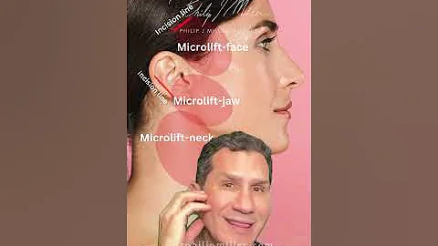 Microlift vs Endoscopic facelift! What are the differences?