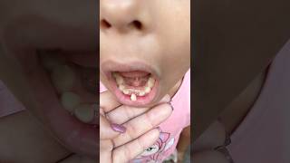 Meu Dentes Nasceu Atrás Do Dente De Leite