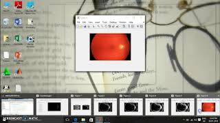 Glaucoma detection