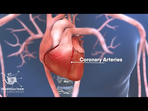 Coronary Angioplasty 3d medical animation  by Dandelion Team