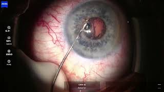 OS 2026 08 03 145201 Phaco ASX 10 small pupil, heavy IFIS