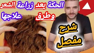 أسباب الحكة بعد زراعة الشعر وطرق العلاج منها