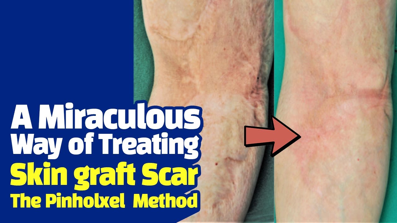 Skin graft scar laser treatment Pinholxel Method YouTube
