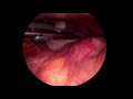 Appendicectomie laparoscopique: agrafage d'une base large par EndoGIA