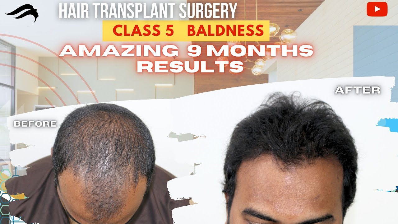 Hair Transplant In Kerala Best Results Surgeon & Cost Of Hair Transplant In Kerala YouTube