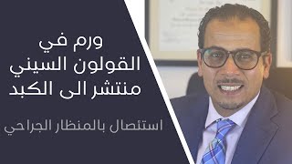 ورم في القولون السيني منتشر الى الكبد