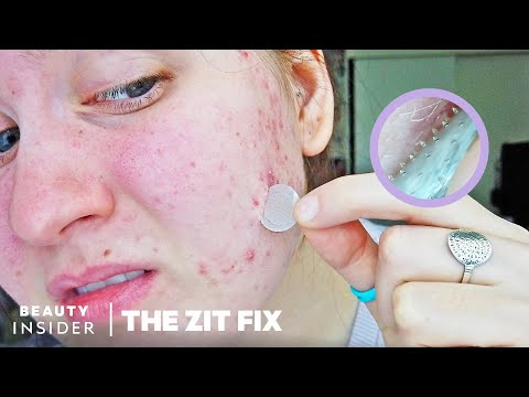 Microneedle Patch Works To Erase Acne Scars And Dark Spots | The Zit Fix