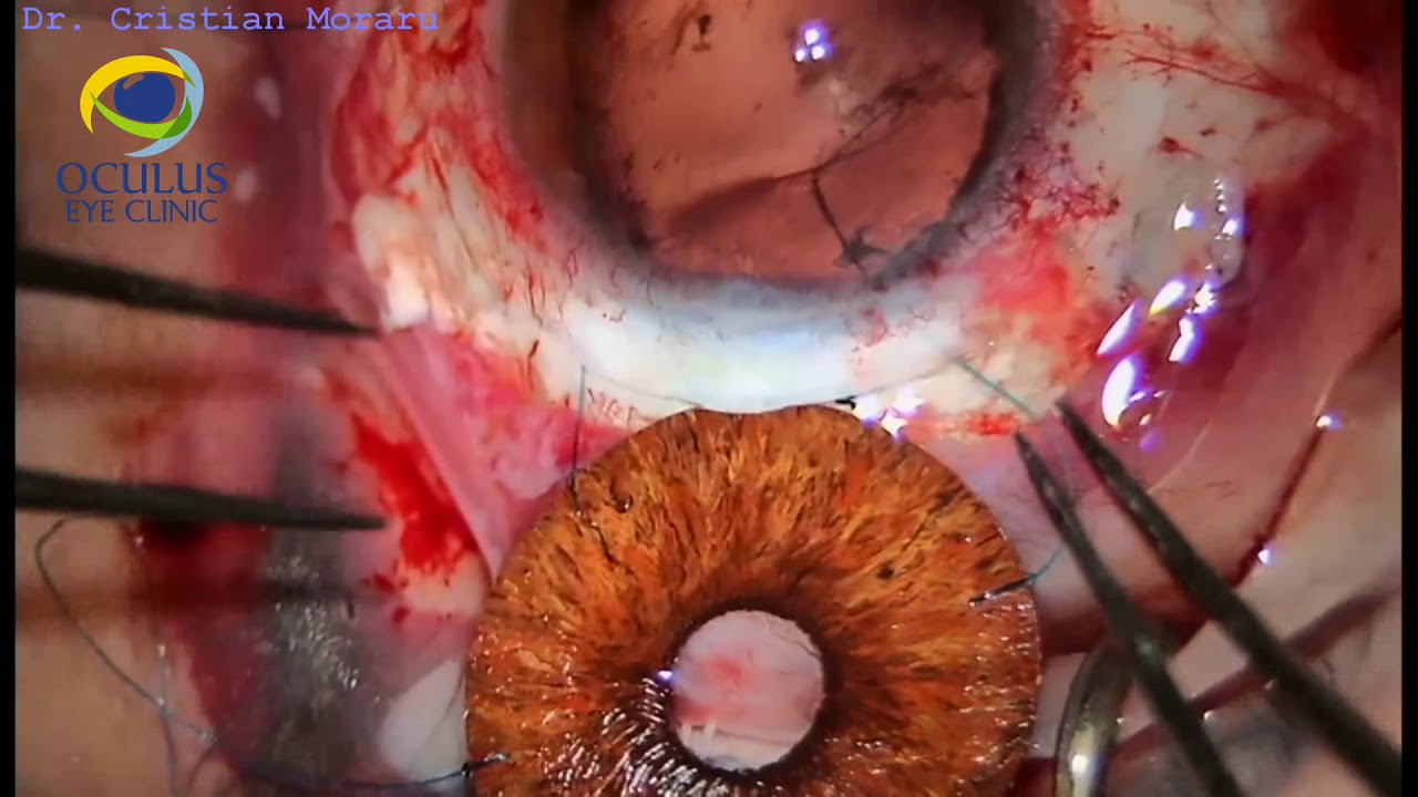 Capsulotomie LASER YAG | Clinica Novaoptic Vedere deteriorată după operația oculară