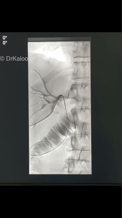 Step by step PTBD (Percutaneous Transhepatic Biliary Drainage) in one minute