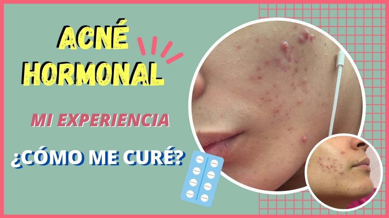 ACNÉ HORMONAL Mi experiencia Caritolinda YouTube