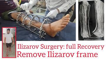 Volledig herstel na Ilizarov-operatie aan het scheenbeen. Niet-genezende fractuur deel 1 #ilizaro...